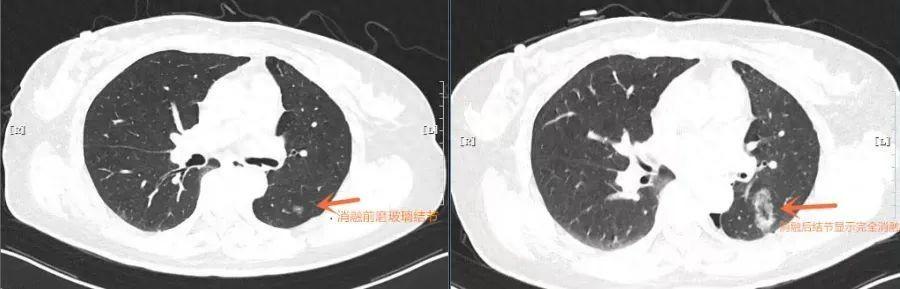 肺查出微波术招结节消融术吗__肺结节微波消融会消不干净吗